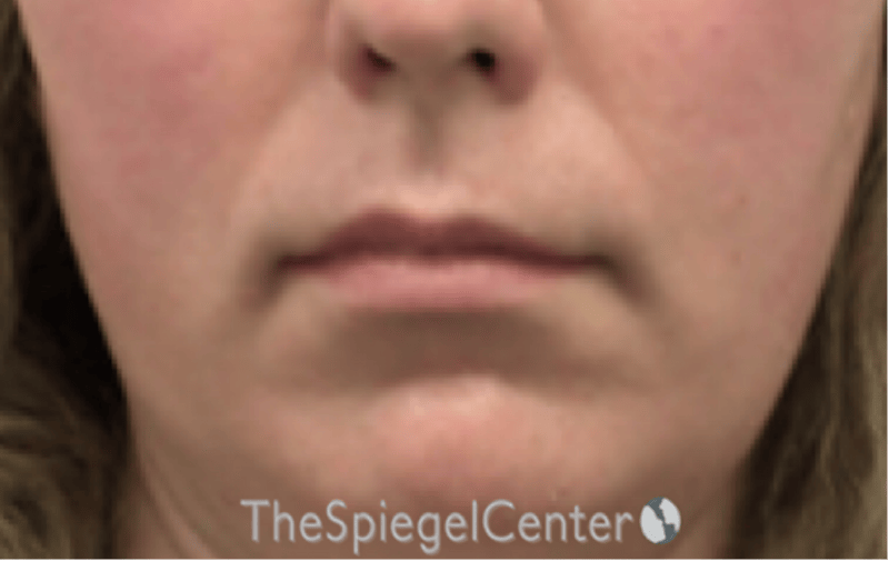 Lip Lift Before & After Gallery - Patient 136845 - Image 1