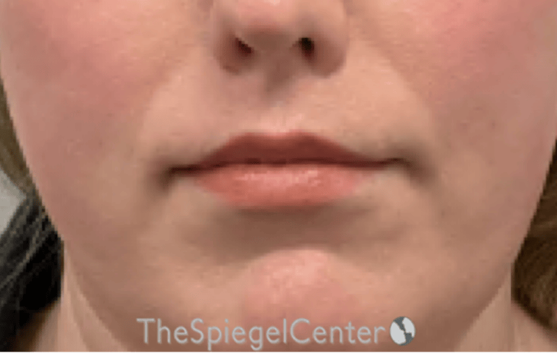 Lip Lift Before & After Gallery - Patient 136845 - Image 2