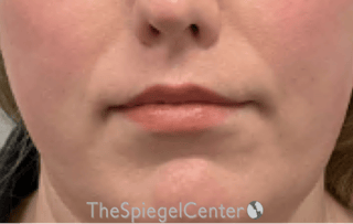 Lip Lift Before & After Gallery - Patient 136845 - Image 2