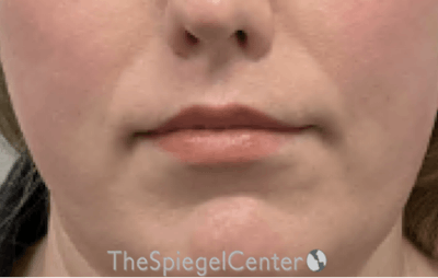 Lip Lift Before & After Gallery - Patient 136845 - Image 2