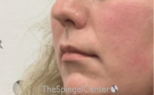 Lip Lift Before & After Gallery - Patient 136845 - Image 3