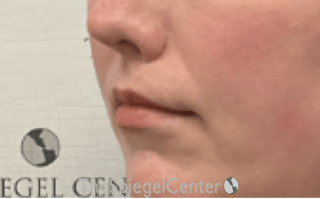Lip Lift Before & After Gallery - Patient 136845 - Image 4