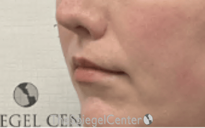 Lip Lift Before & After Gallery - Patient 136845 - Image 4