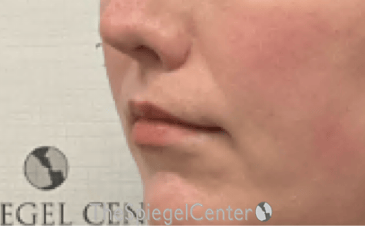 Lip Lift Before & After Gallery - Patient 136845 - Image 4