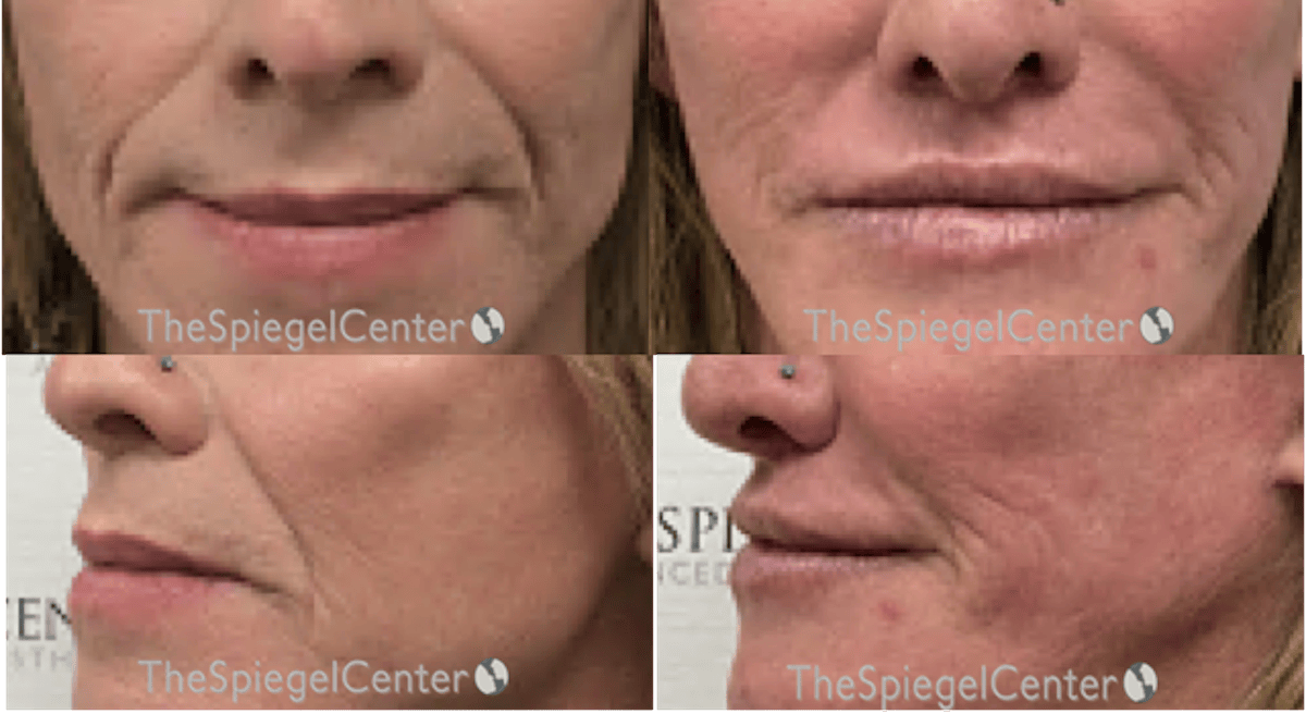 Lip Lift Before & After Gallery - Patient 285432 - Image 1