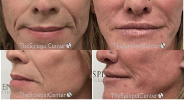 Lip Lift Before & After Gallery - Patient 285432 - Image 1