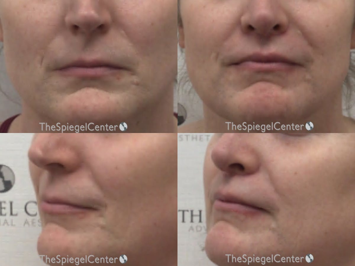 Lip Lift Before & After Gallery - Patient 119012 - Image 1