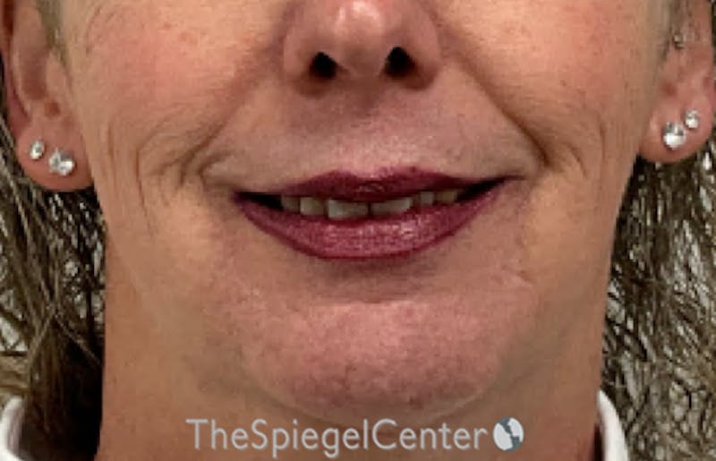 Lip Lift Before & After Gallery - Patient 226092 - Image 1