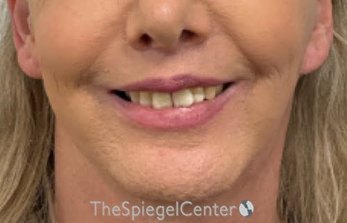 Lip Lift Before & After Gallery - Patient 226092 - Image 2