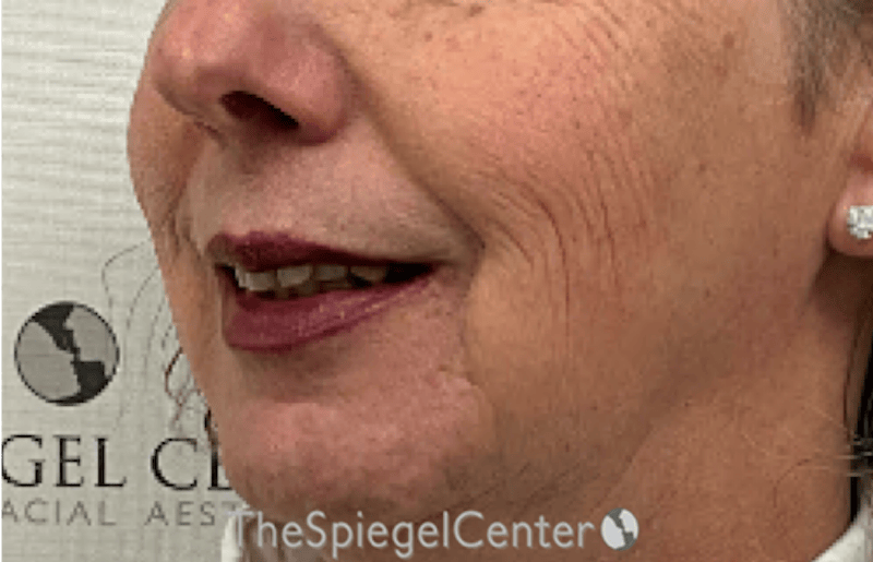 Lip Lift Before & After Gallery - Patient 226092 - Image 3