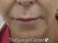 Lip Lift Before & After Gallery - Patient 373954 - Image 1