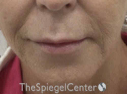 Lip Lift Before & After Gallery - Patient 373954 - Image 1