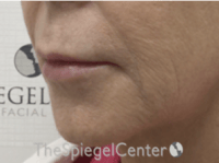 Lip Lift Before & After Gallery - Patient 373954 - Image 3