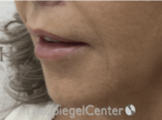 Lip Lift Before & After Gallery - Patient 373954 - Image 4