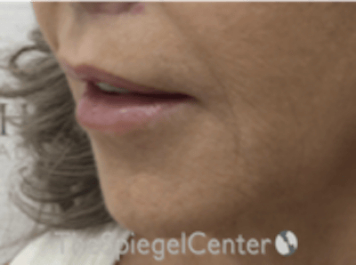 Lip Lift Before & After Gallery - Patient 373954 - Image 4
