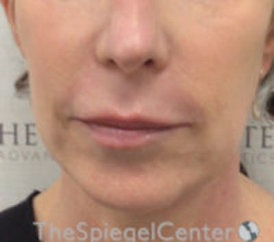 Lip Lift Before & After Gallery - Patient 427433 - Image 1