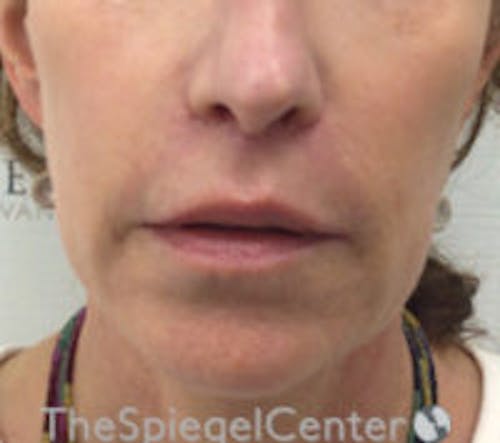 Lip Lift Before & After Gallery - Patient 427433 - Image 2