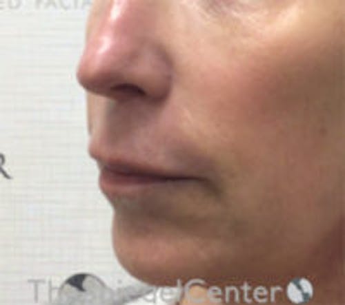 Lip Lift Before & After Gallery - Patient 427433 - Image 3