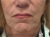 Lip Lift Before & After Gallery - Patient 282822 - Image 1