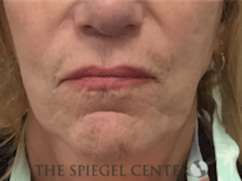 Lip Lift Before & After Gallery - Patient 282822 - Image 1