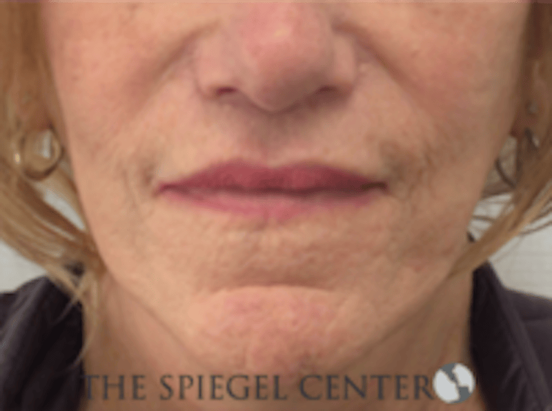 Lip Lift Before & After Gallery - Patient 282822 - Image 2