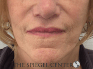 Lip Lift Before & After Gallery - Patient 282822 - Image 2