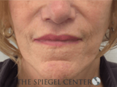 Lip Lift Before & After Gallery - Patient 282822 - Image 2