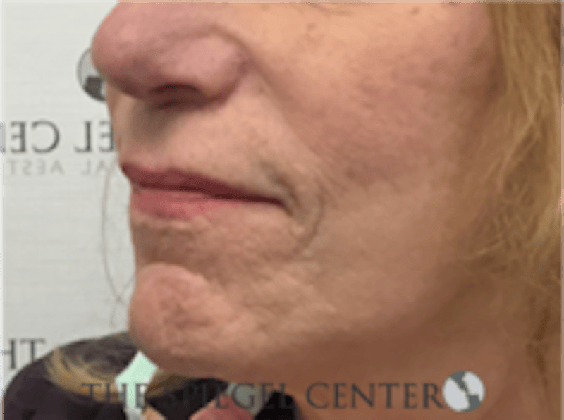 Lip Lift Before & After Gallery - Patient 282822 - Image 3