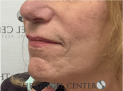 Lip Lift Before & After Gallery - Patient 282822 - Image 3