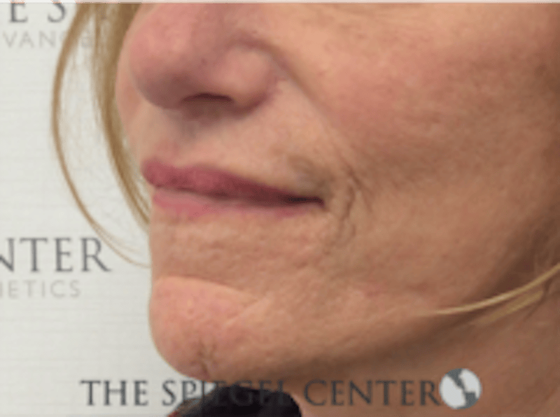 Lip Lift Before & After Gallery - Patient 282822 - Image 4