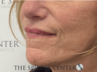 Lip Lift Before & After Gallery - Patient 282822 - Image 4