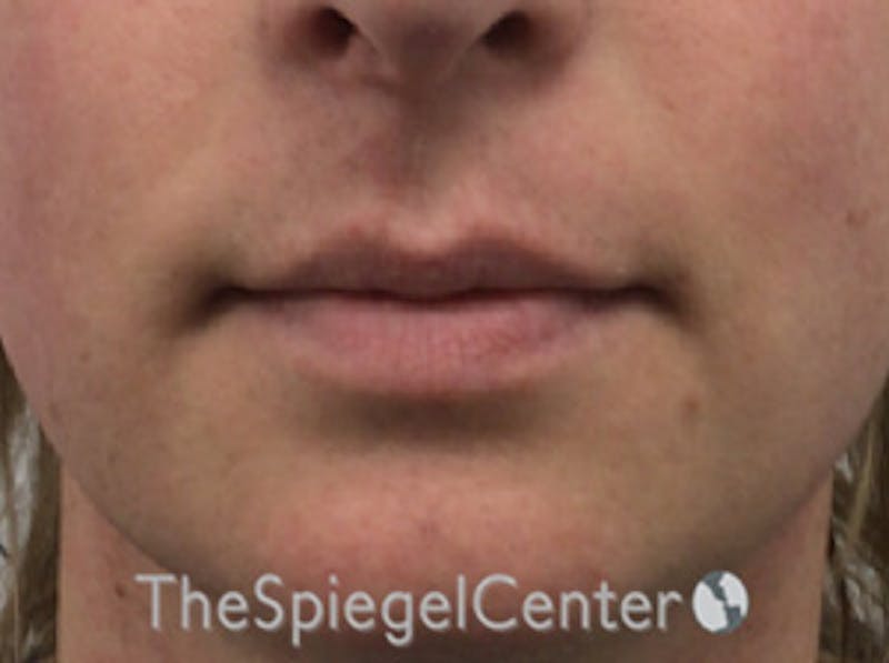 Lip Lift Before & After Gallery - Patient 117869 - Image 1
