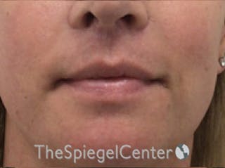 Lip Lift Before & After Gallery - Patient 117869 - Image 2