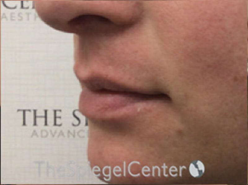 Lip Lift Before & After Gallery - Patient 117869 - Image 3
