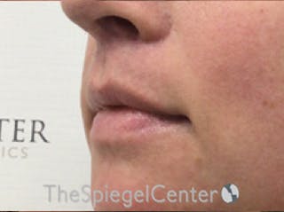 Lip Lift Before & After Gallery - Patient 117869 - Image 4