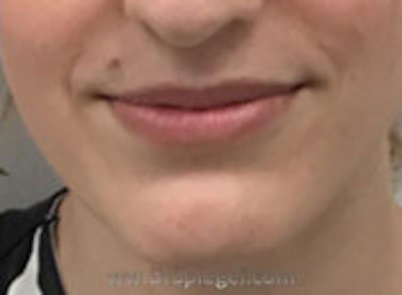 Lip Lift Before & After Gallery - Patient 617436 - Image 1
