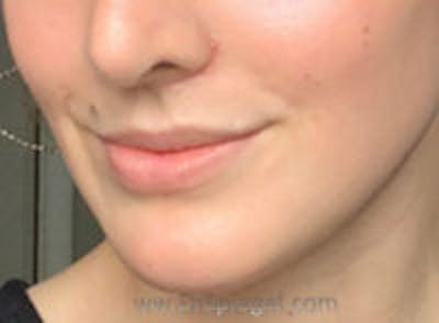 Lip Lift Before & After Gallery - Patient 617436 - Image 2