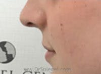 Lip Lift Before & After Gallery - Patient 617436 - Image 3