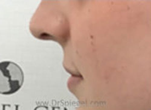 Lip Lift Before & After Gallery - Patient 617436 - Image 3