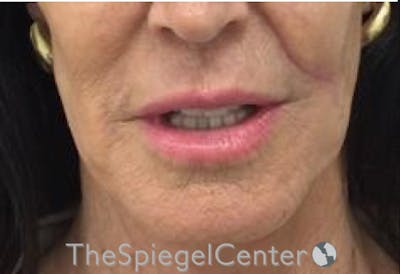 Lip Lift Before & After Gallery - Patient 141928 - Image 1