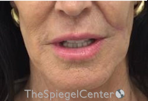 Lip Lift Before & After Gallery - Patient 141928 - Image 1