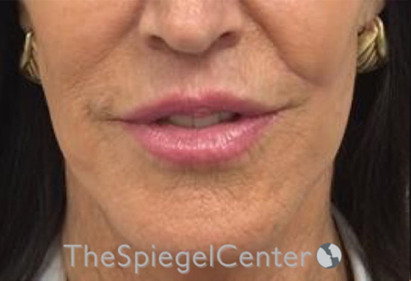 Lip Lift Before & After Gallery - Patient 141928 - Image 2