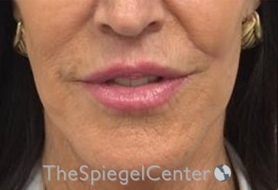 Lip Lift Before & After Gallery - Patient 141928 - Image 2