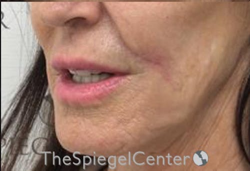Lip Lift Before & After Gallery - Patient 141928 - Image 3