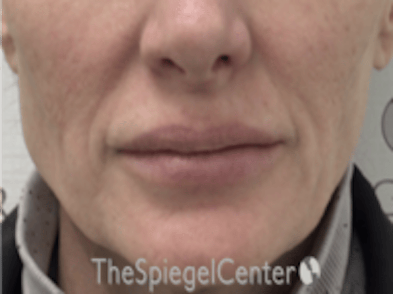 Lip Lift Before & After Gallery - Patient 336537 - Image 1