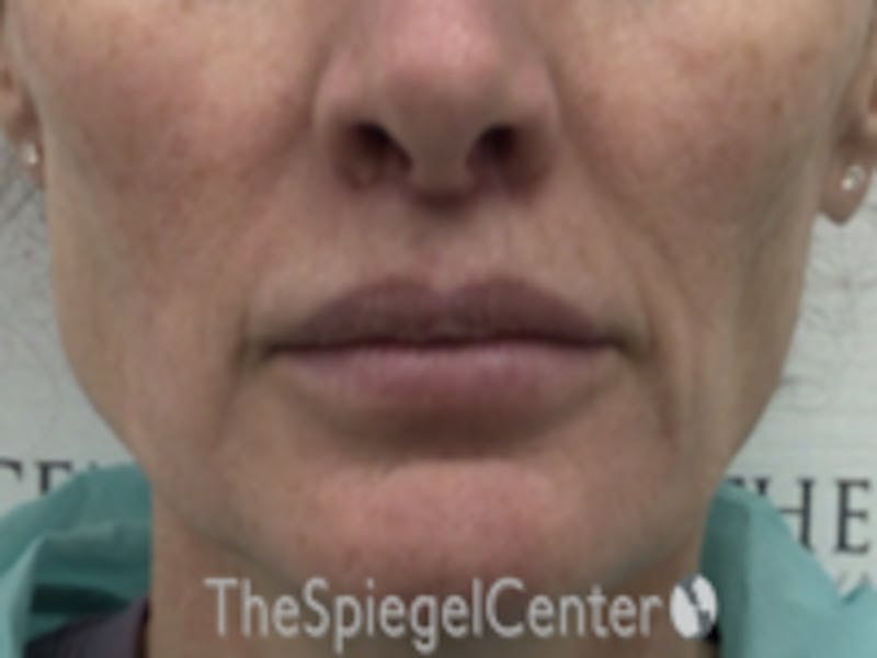 Lip Lift Before & After Gallery - Patient 336537 - Image 2