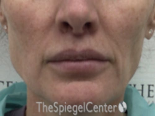 Lip Lift Before & After Gallery - Patient 336537 - Image 2