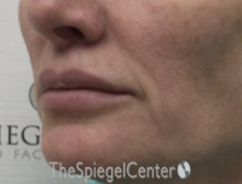 Lip Lift Before & After Gallery - Patient 336537 - Image 4