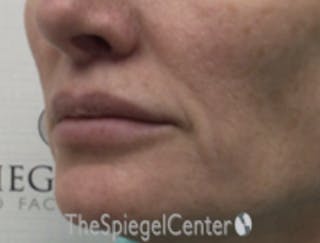 Lip Lift Before & After Gallery - Patient 336537 - Image 4