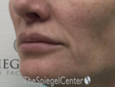 Lip Lift Before & After Gallery - Patient 336537 - Image 4